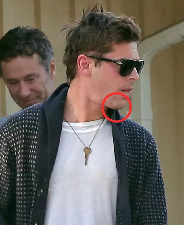 zac efron mandibula accidente