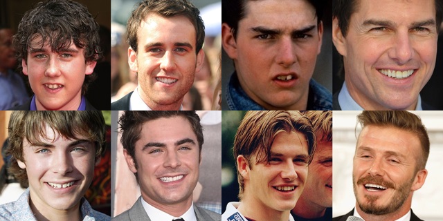El 'antes y el después' de los dientes de los famosos