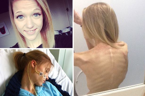 La historia de India Edmons, una adolescente que luchó contra la anorexia La historia de India Edmons, una adolescente que luchó contra la anorexia
