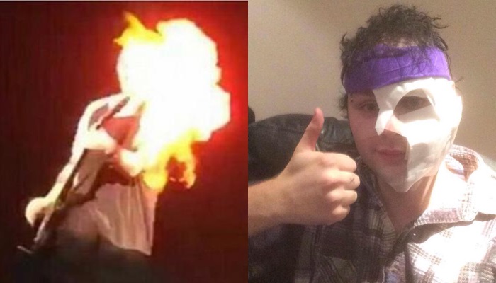 Michael Clifford se quema la cara en un concierto