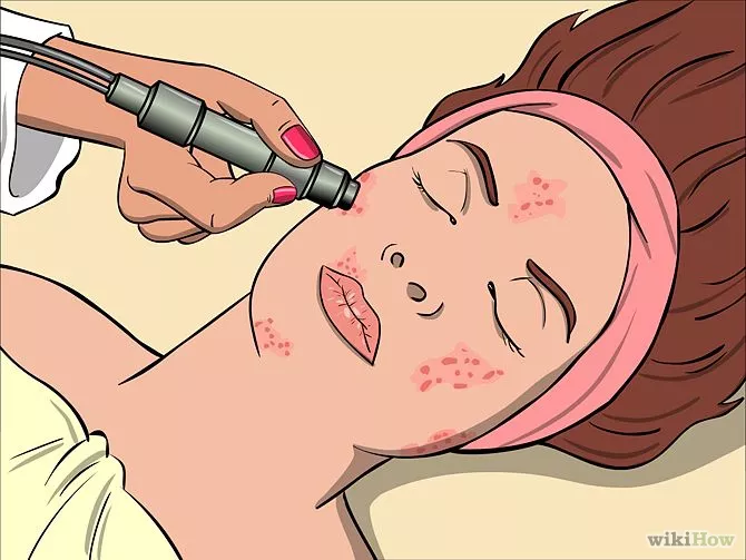 Consejos para llevar el acné lo mejor posible 