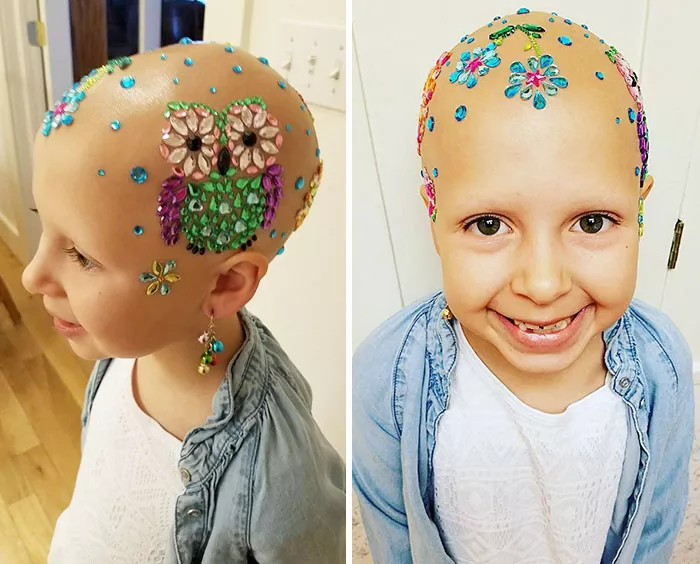 niña con alopecia inventa peinado 