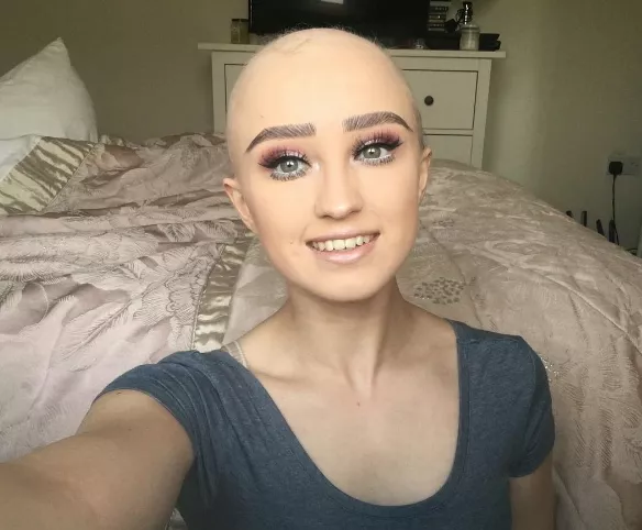 Instagramer confiesa alopecia