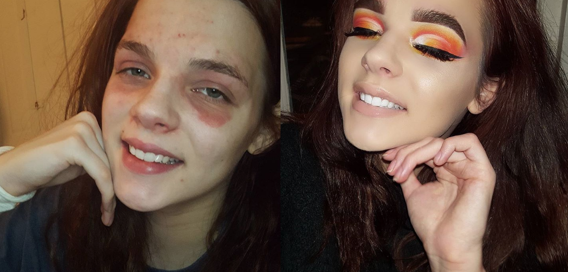Convierte su eczema en arte gracias al maquillaje