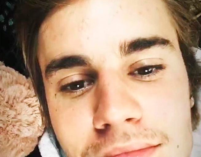 Justin Bieber muestra sus granos en Instagram