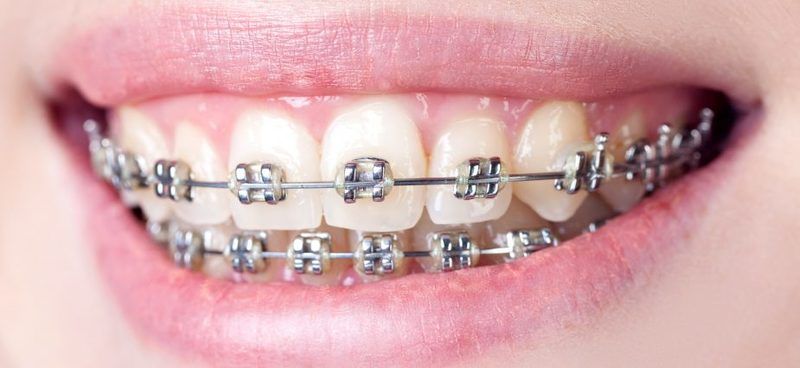 Cómo es realmente llevar ortodoncia: ¿Valen la pena?