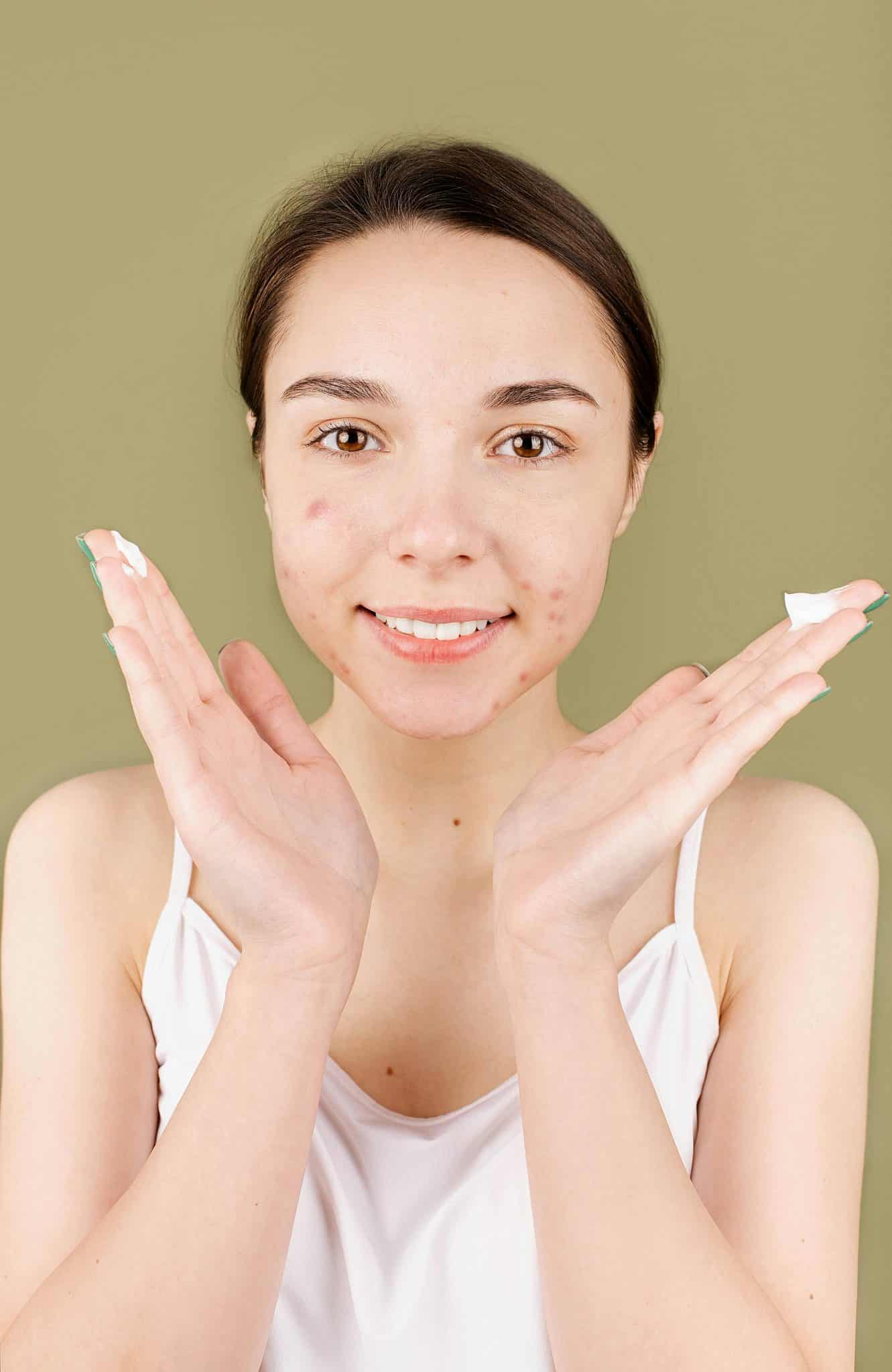 7 formas eficaces de combatir las cicatrices del acné