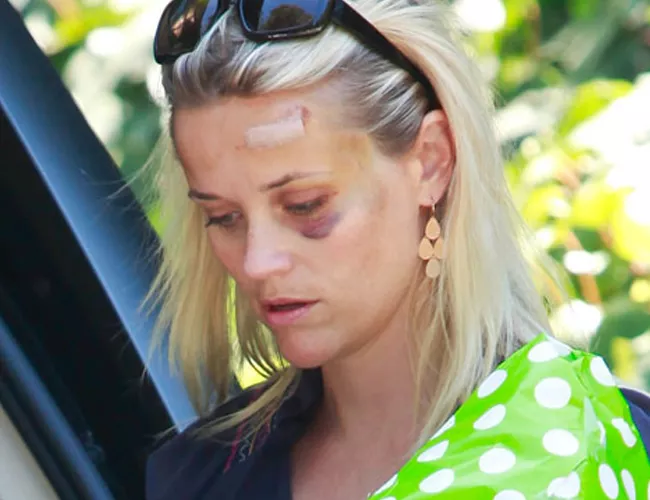 reese accidente